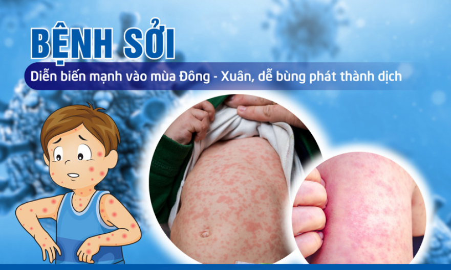 Khẩn trương xử l&yacute; ổ dịch sởi tại x&atilde; Chiềng Sinh