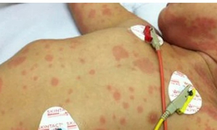 Kh&ocirc;ng để dịch bệnh vi&ecirc;m m&agrave;ng n&atilde;o m&ocirc; cầu lan rộng tại cộng đồng