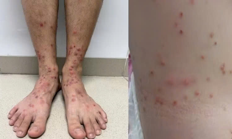 Gia tăng ca bệnh sẩn ngứa do bọ ch&eacute;t, nhiều người tự điều trị sai c&aacute;ch